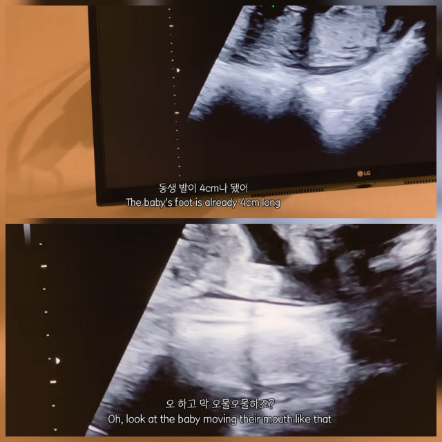 박주호 아내 안나 넷째 임신 Q&A 정리: 암 회복 이후 건강 우려에 답하다